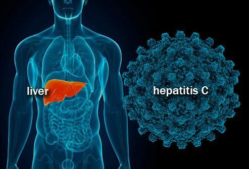 2fa11d0-getty-rm-illustration-of-hepatitis-c